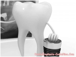 dental-implants-in-costa-rica