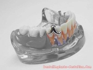 implants-and-overdentures-costa-rica