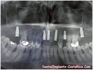 zygoma-implants-in-costa-rica