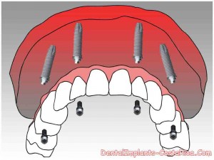 all-on-4-dental-implants-in-cr