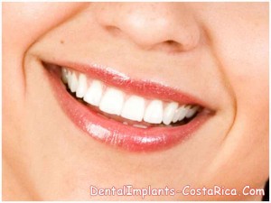 Smile Veneers vs Lumineers in Costa Rica