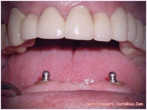 snap-on-dentures-in-costa-rica_0