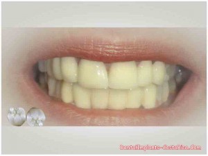 ceramic-crowns