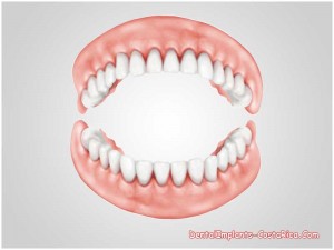 Immediate dentures