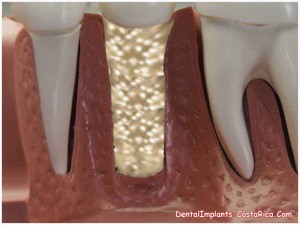Teeth bone graft in Costa Rica