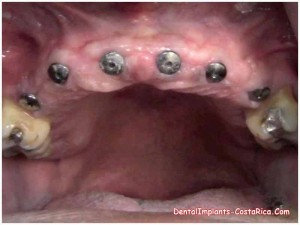 All-on-6 and All-on-8 Implants in Costa Rica 