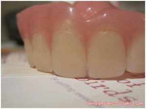 Fixed dentures in San Jose - Costa Rica