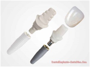 Straumann implants in Costa Rica