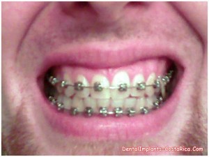 An Accelerated-orthodontics Patient