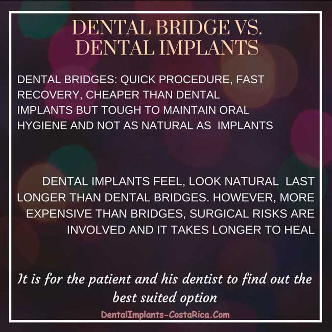 Dental Bridges vs. Dental Implants