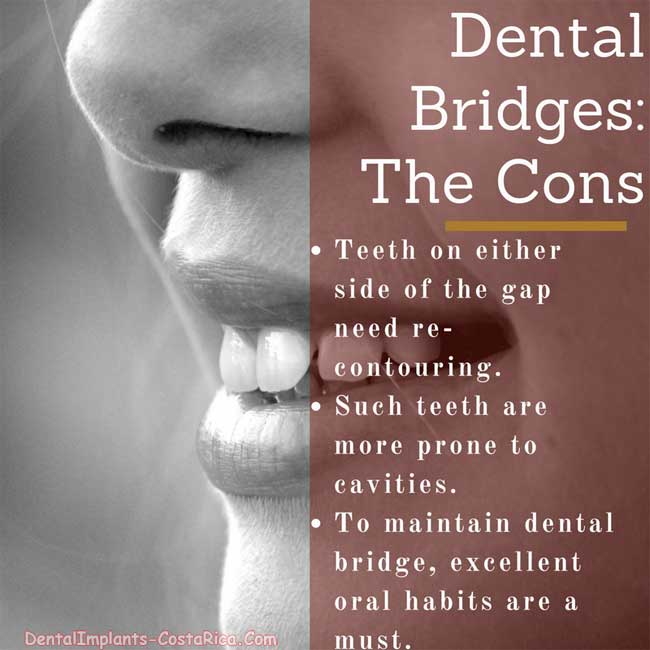 Dental Bridges Disadvantages