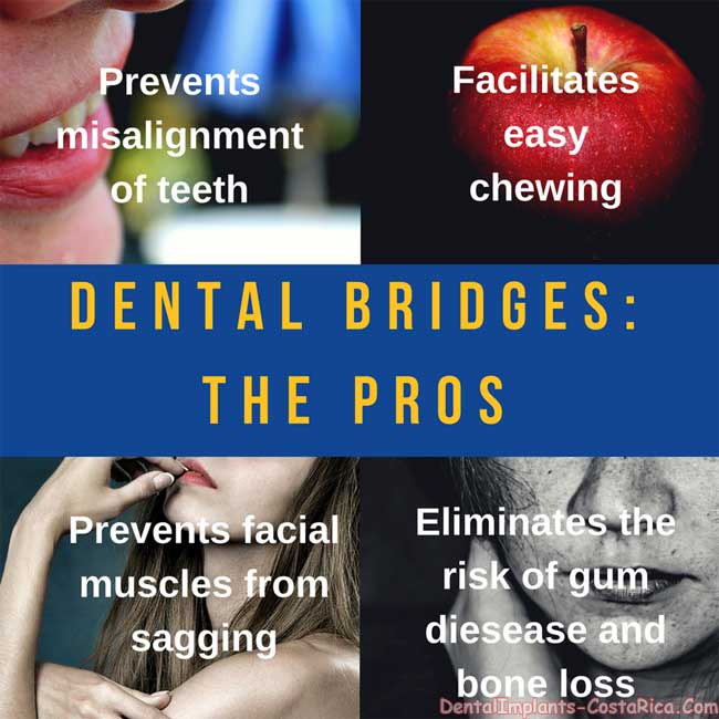 Dental Bridges Advantages