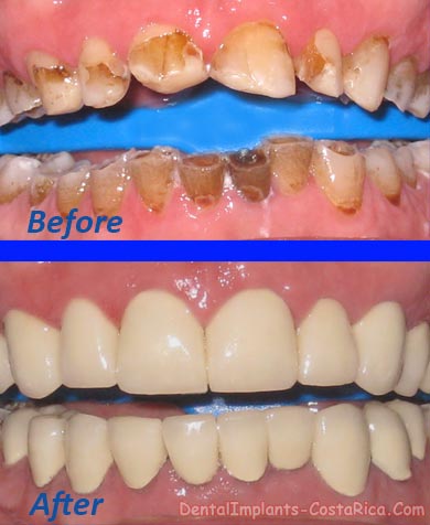 Full Mouth Restoration in Costa Rica