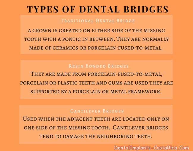 Types of Dental Bridges