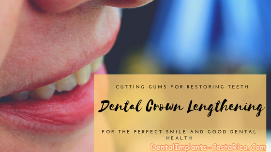 dental crown lengthening in costa rica