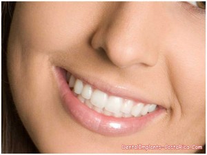 Porcelain veneers in San Jose - Costa Rica